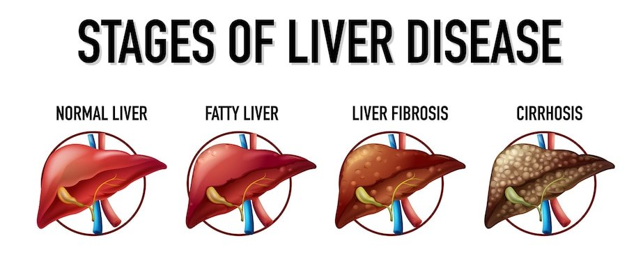 best Liver Disorder in North Delhi.