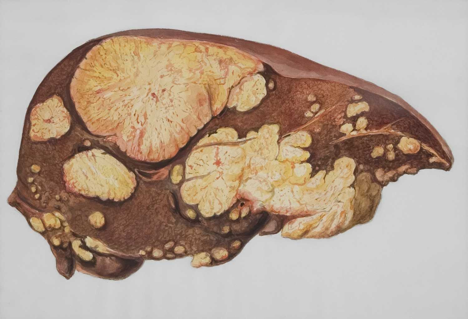 Fatty Liver Treatment in Rohini