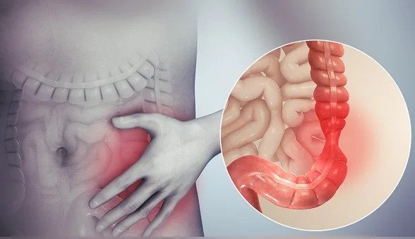 Irritable Bowel Syndrome Treatment in Pitampura