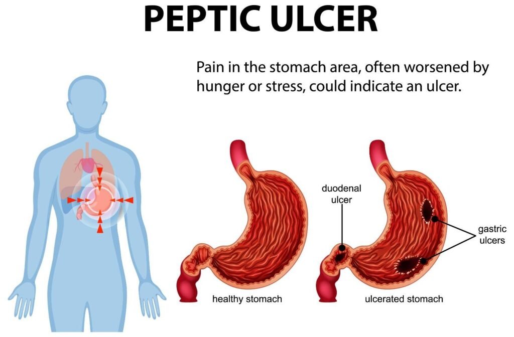 Peptic Ulcer Treatment in Pitampura