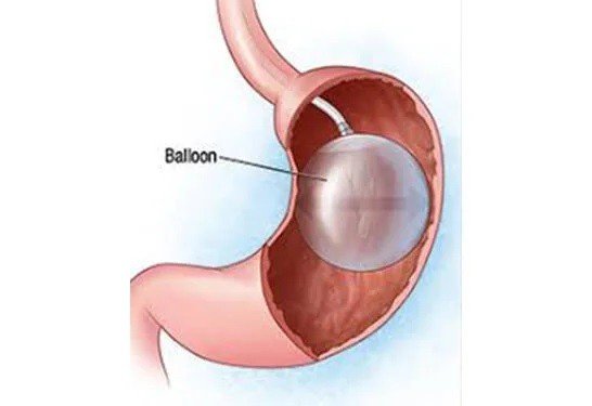 Gastric Balloon Treatment in Pitampura